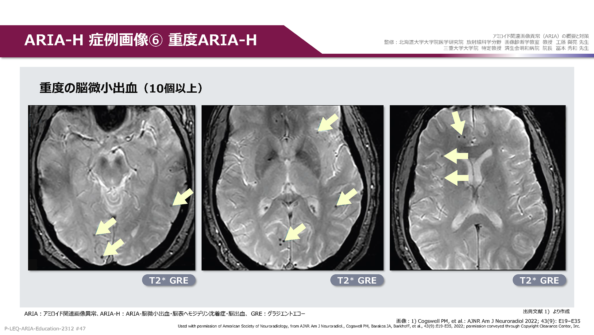 ARIA e-learning レケンビ エーザイ Medical.eisai.jp 医療関係者向けサイト