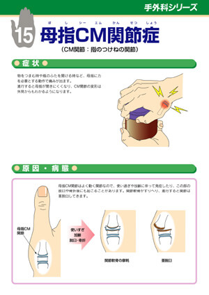 母指CM関節症