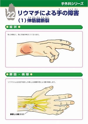 リウマチによる手の障害（１）伸筋腱断裂