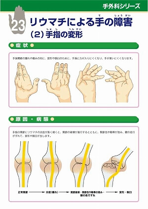 リウマチによる手の障害（２）手指の変形