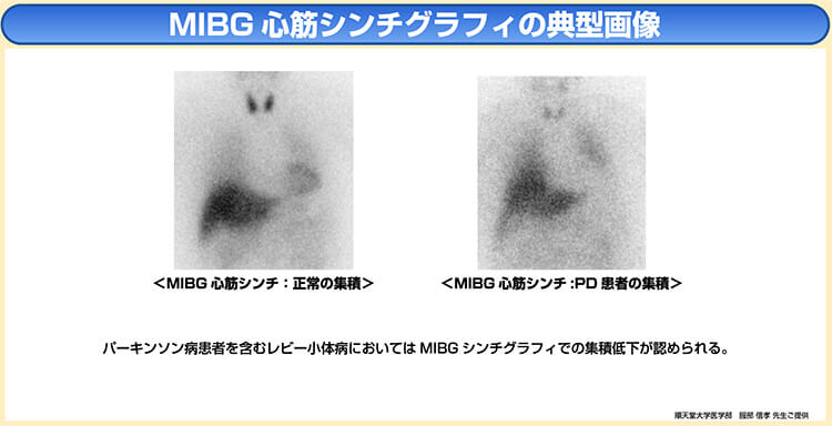 MIBG心筋シンティグラフィの典型画像